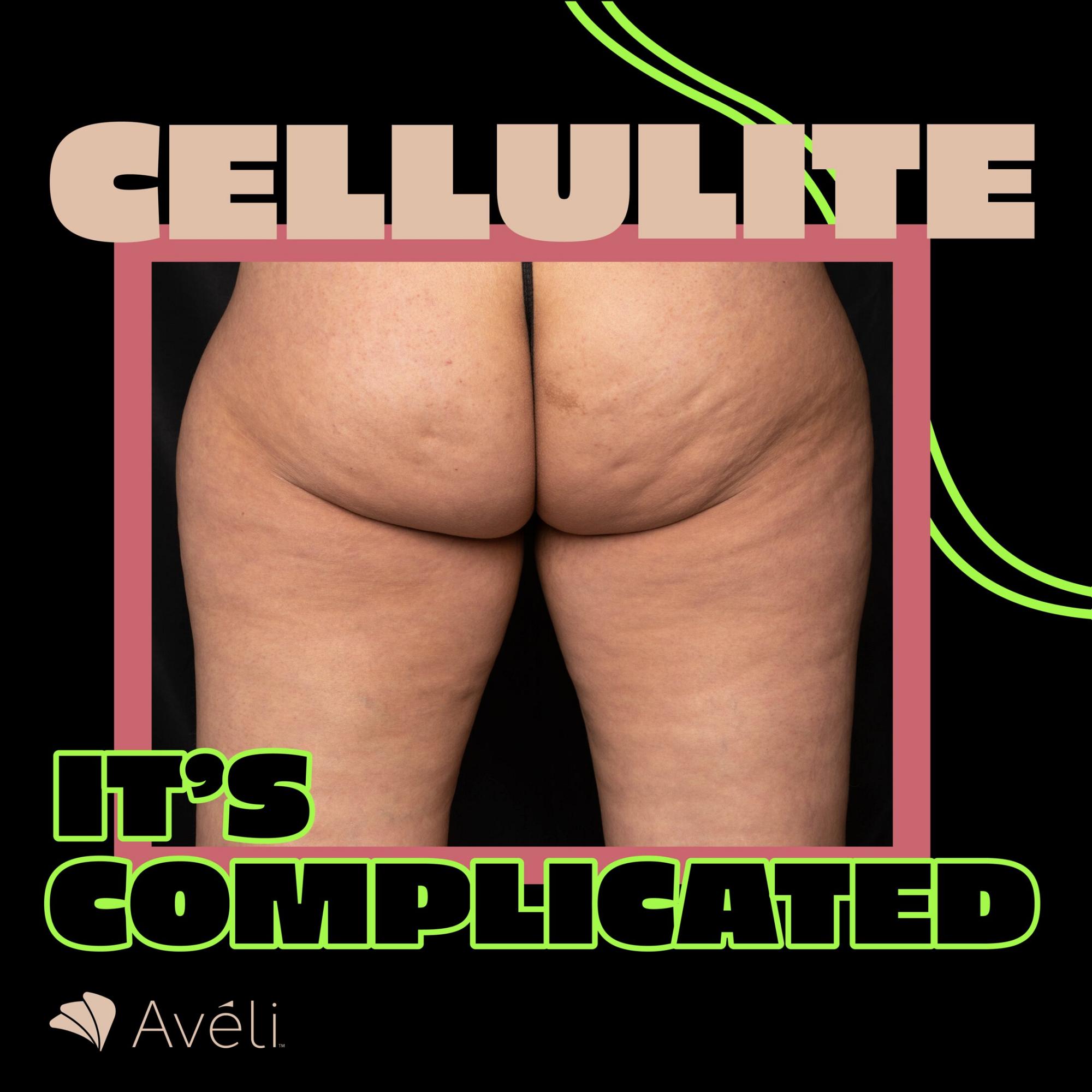 Aveli Cellulite infographic