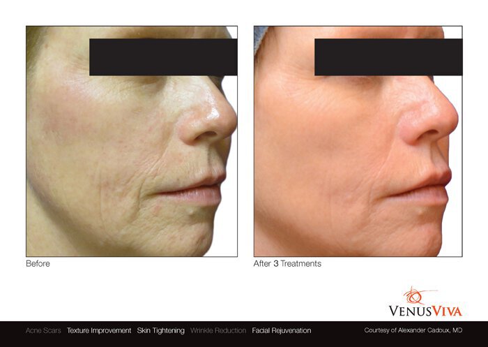 Venus Viva before and after photo