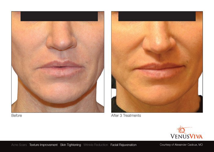 Venus Viva before and after photo