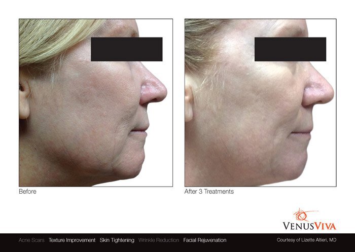 Venus Viva before and after photo