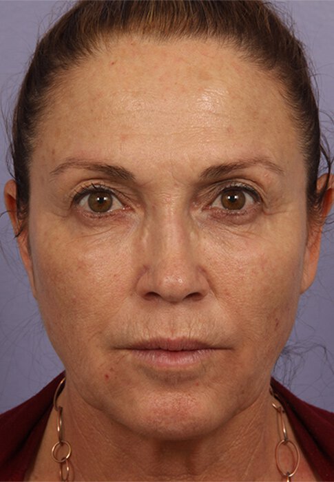 Skin Rejuvenation Before and After