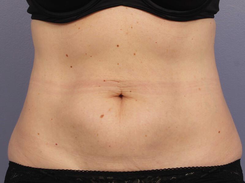 CoolSculpting Gallery Before & After Image