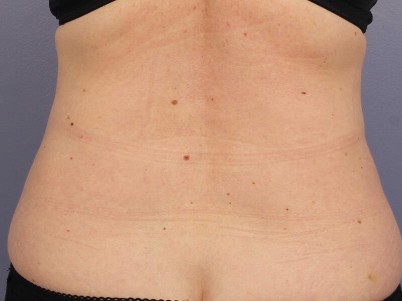 CoolSculpting Gallery Before & After Image