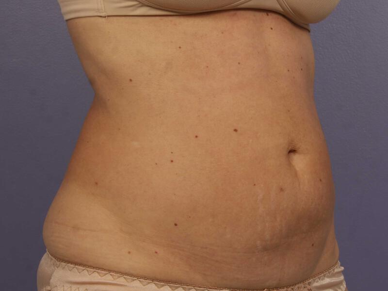 CoolSculpting Gallery Before & After Image