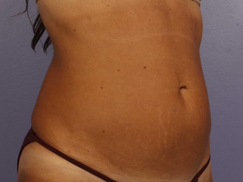 CoolSculpting Gallery Before & After Image