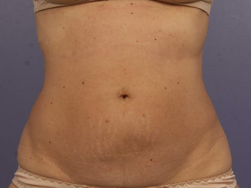 CoolSculpting Gallery Before & After Image