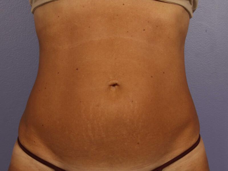 CoolSculpting Gallery Before & After Image