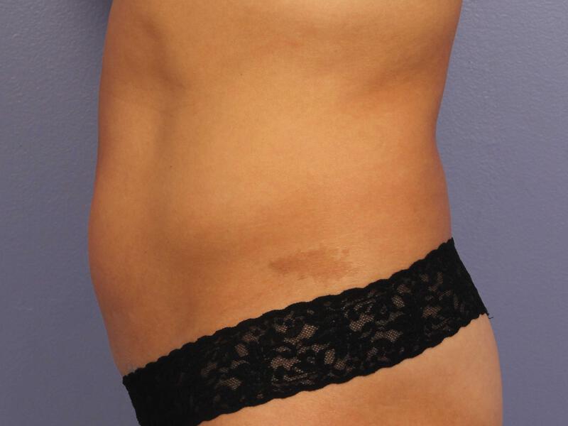 CoolSculpting Gallery Before & After Image