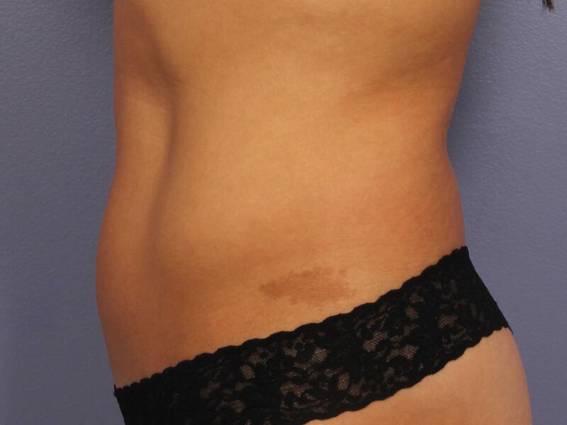 CoolSculpting Gallery Before & After Image