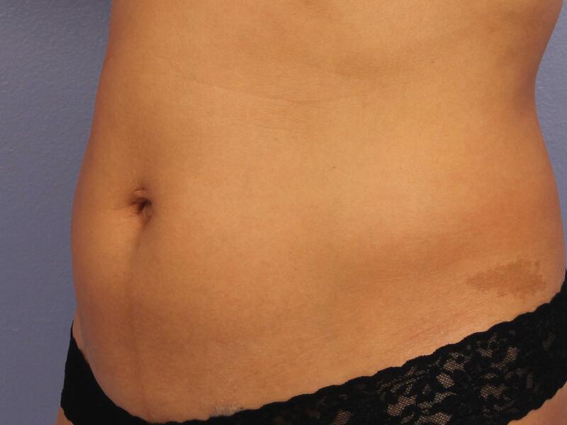 CoolSculpting Gallery Before & After Image