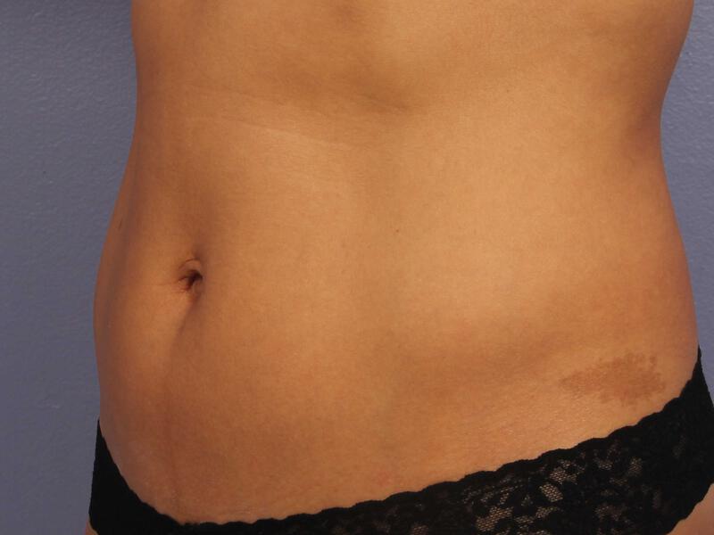 CoolSculpting Gallery Before & After Image