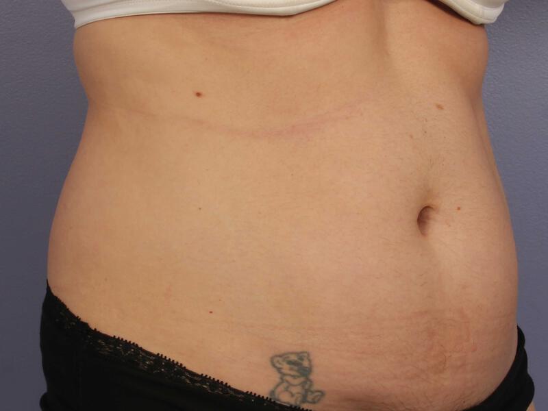 CoolSculpting Gallery Before & After Image