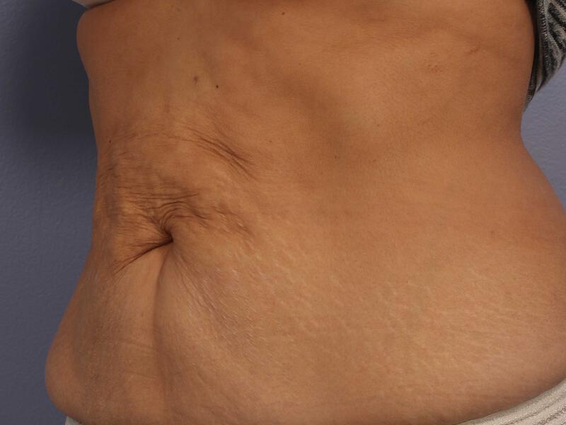 CoolSculpting Gallery Before & After Image