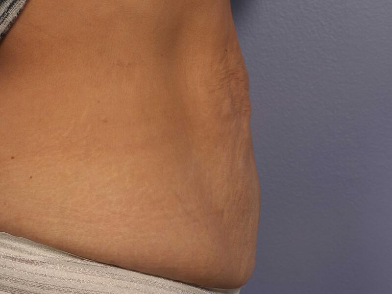 CoolSculpting Gallery Before & After Image