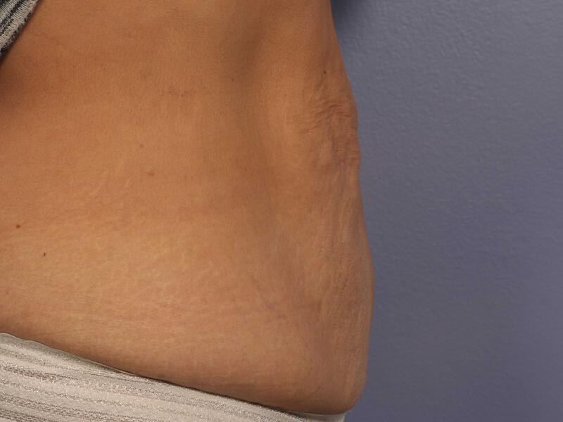 CoolSculpting Gallery Before & After Image