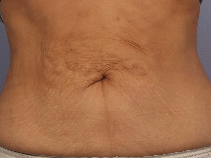 CoolSculpting Gallery Before & After Image