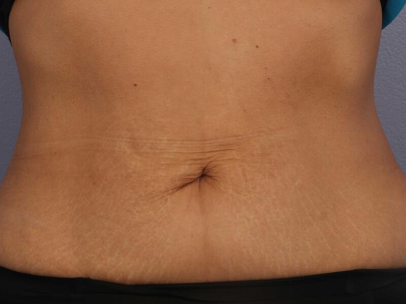 CoolSculpting Gallery Before & After Image