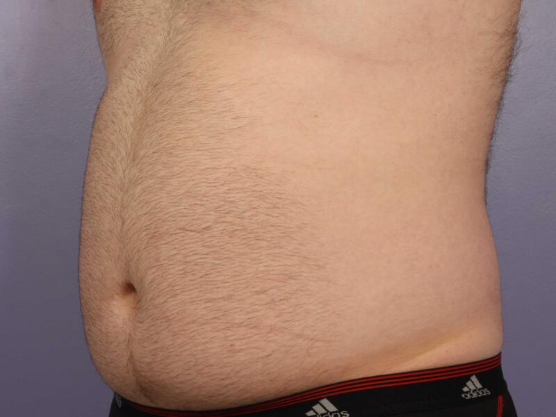 CoolSculpting Gallery Before & After Image