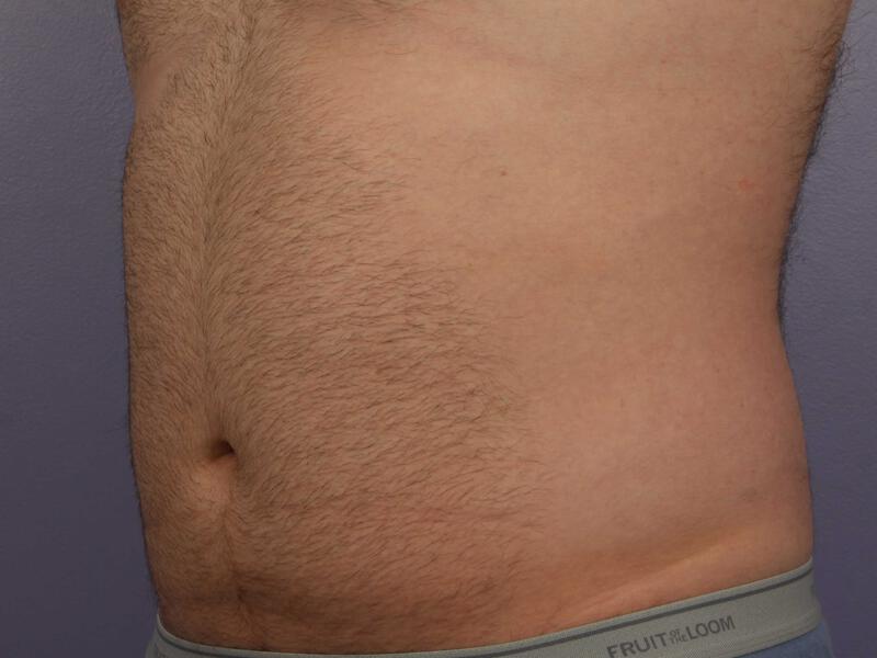 CoolSculpting Gallery Before & After Image