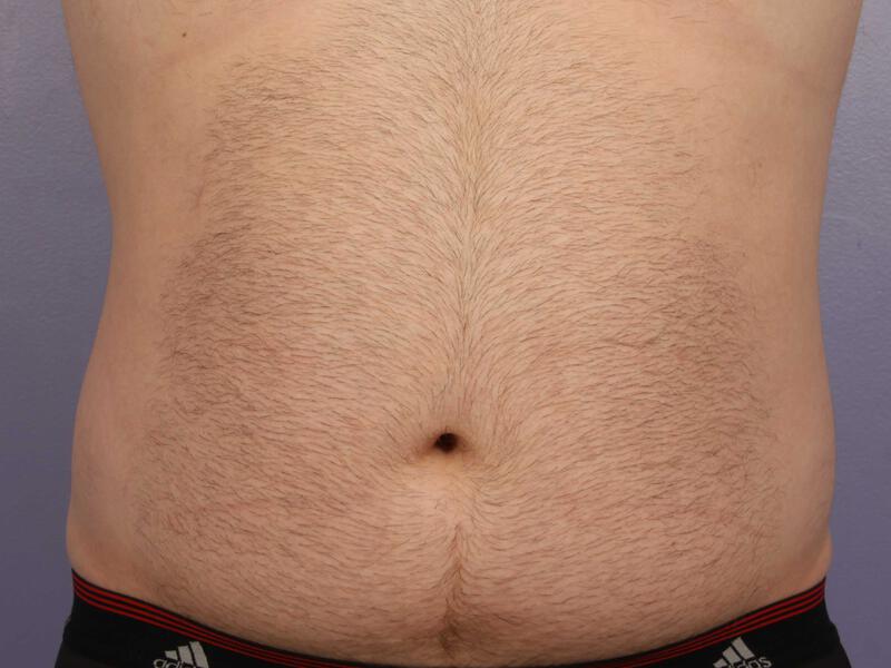 CoolSculpting Gallery Before & After Image