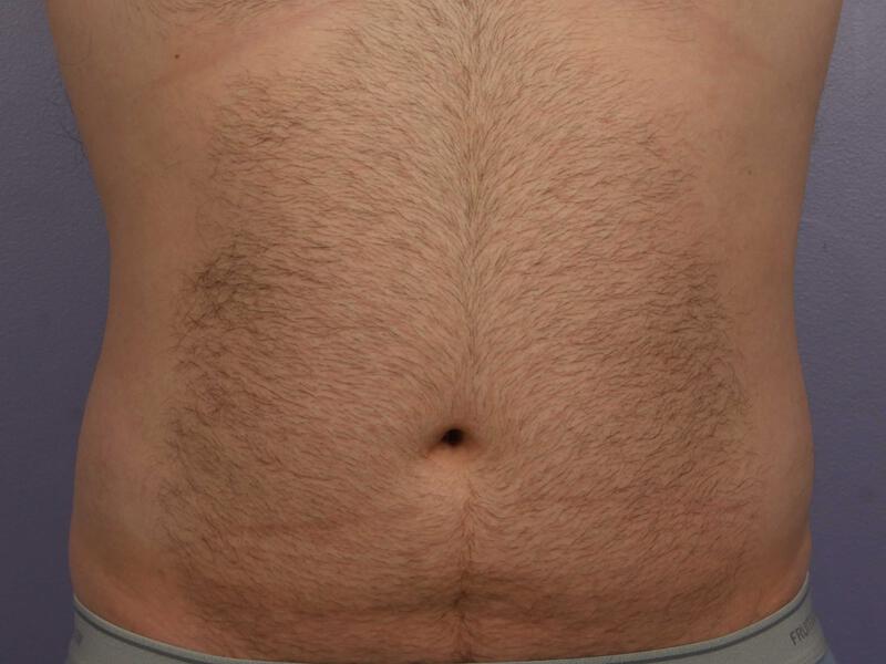 CoolSculpting Gallery Before & After Image