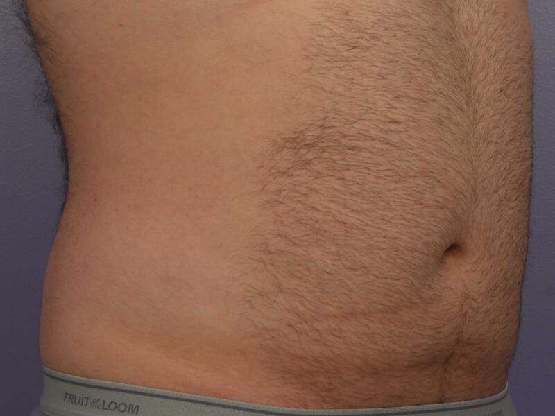 CoolSculpting Gallery Before & After Image