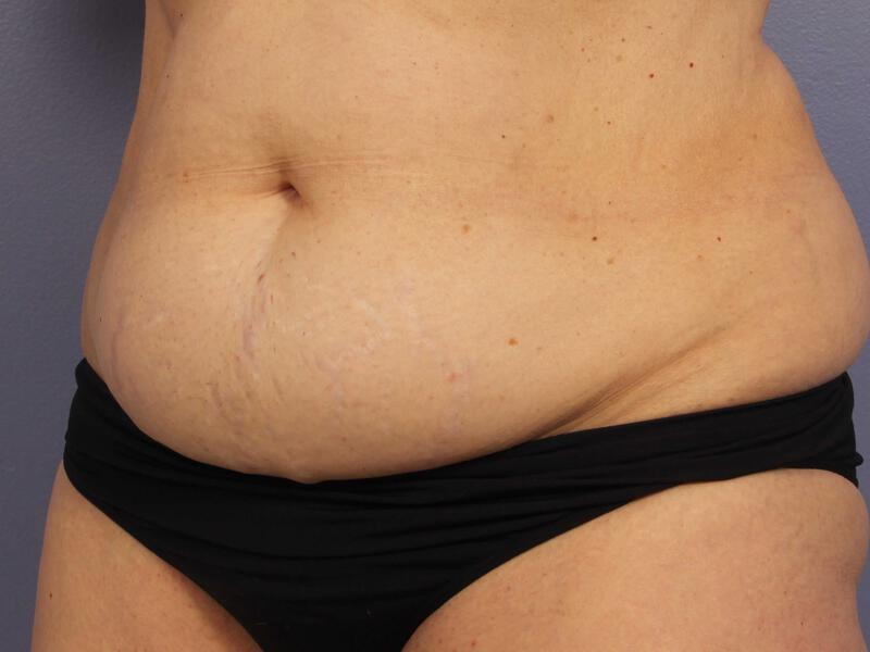 CoolSculpting Gallery Before & After Image