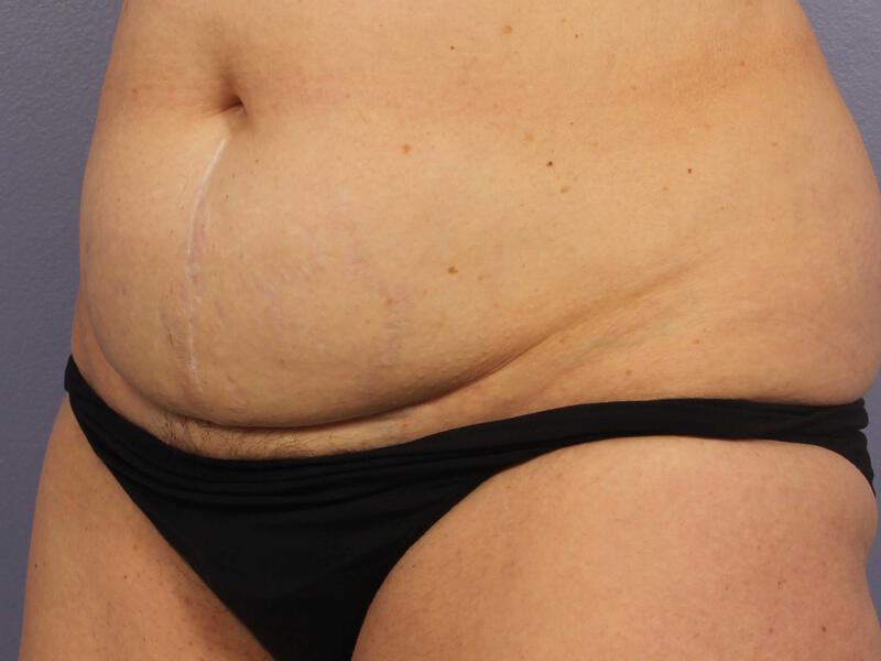 CoolSculpting Gallery Before & After Image