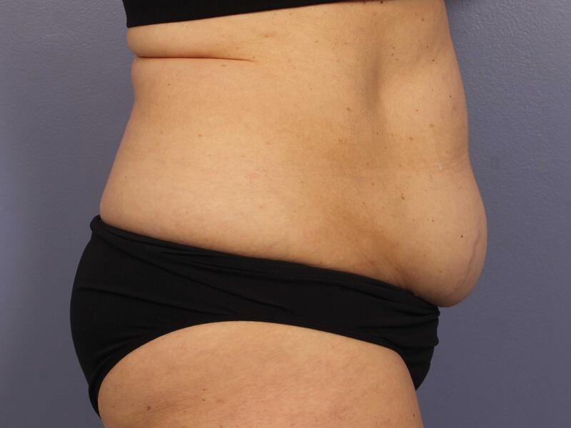 CoolSculpting Gallery Before & After Image