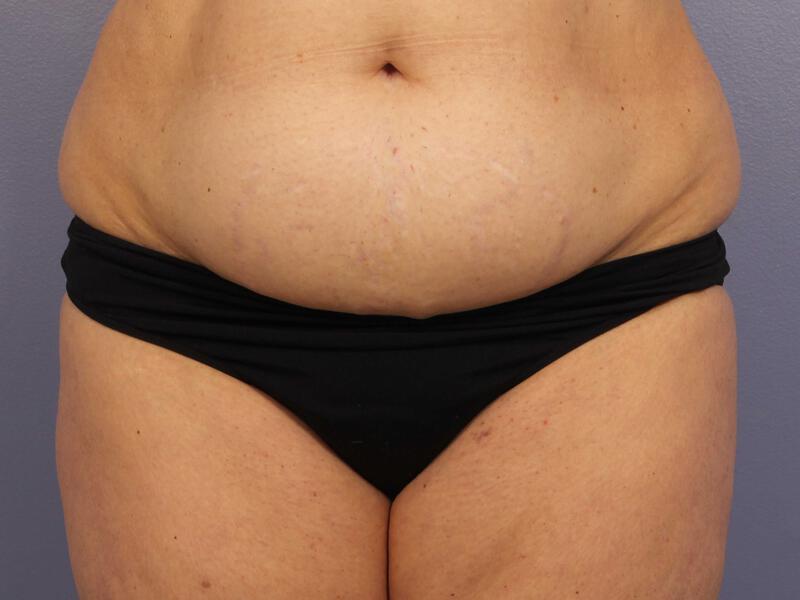 CoolSculpting Gallery Before & After Image