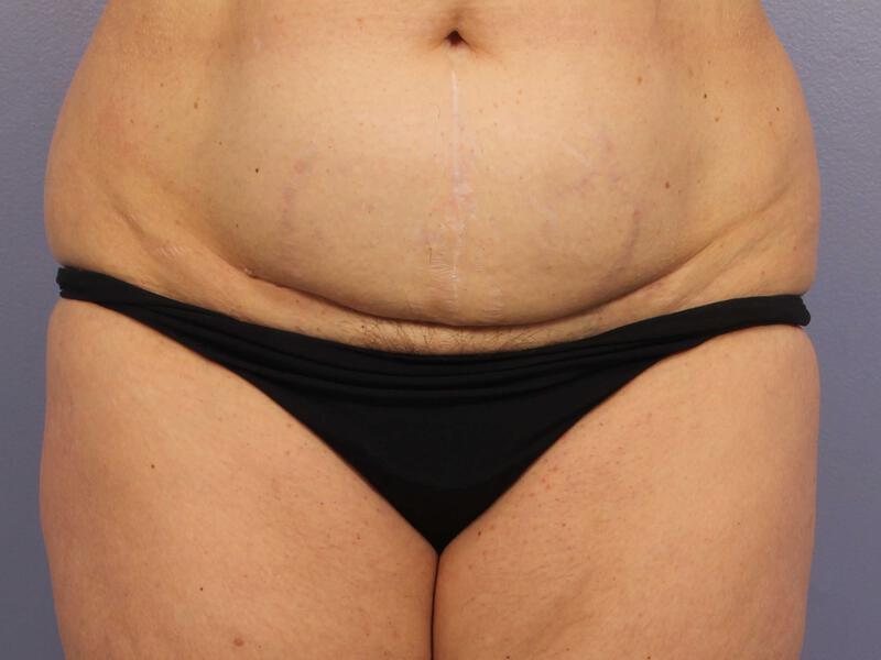 CoolSculpting Gallery Before & After Image