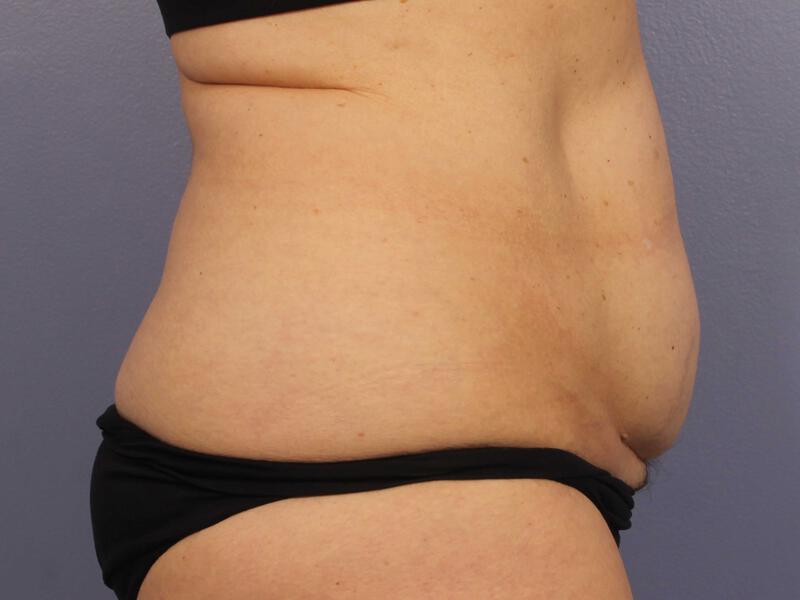 CoolSculpting Gallery Before & After Image