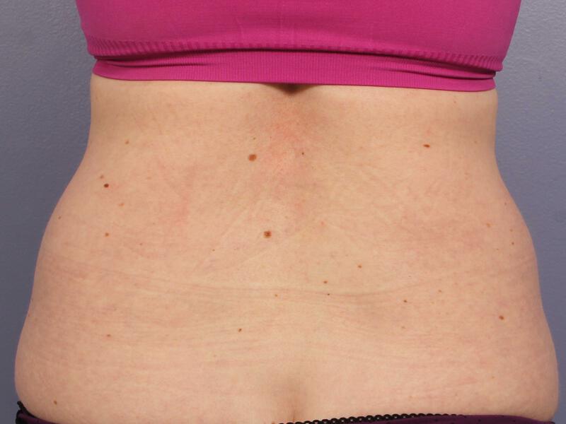 CoolSculpting Gallery Before & After Image