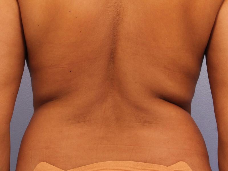 CoolSculpting Gallery Before & After Image