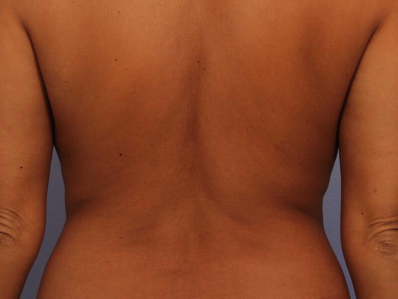 CoolSculpting Gallery Before & After Image