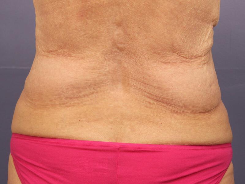 CoolSculpting Gallery Before & After Image