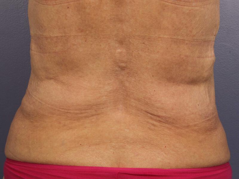 CoolSculpting Gallery Before & After Image