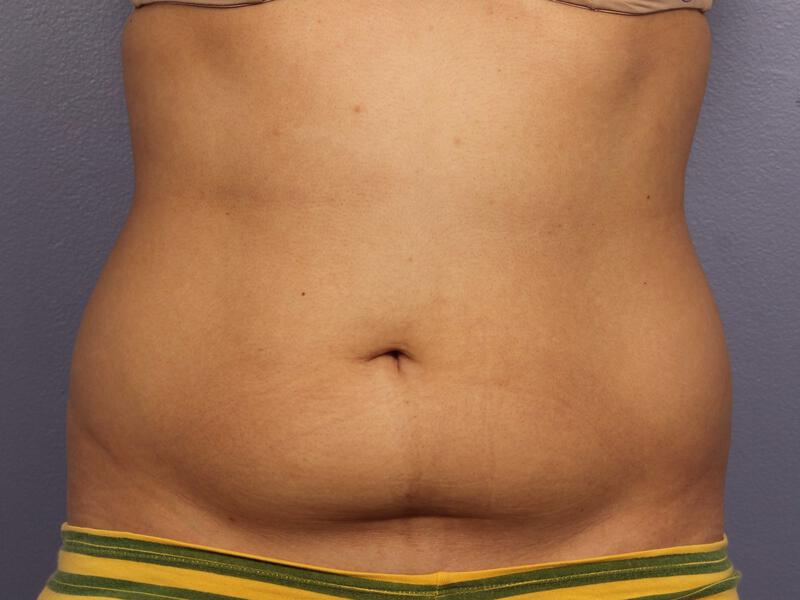 CoolSculpting Gallery Before & After Image