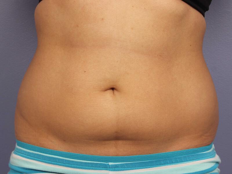 CoolSculpting Gallery Before & After Image