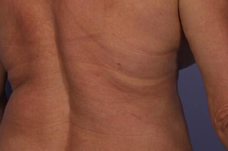 CoolSculpting Gallery Before & After Image