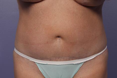 CoolSculpting Gallery Before & After Image