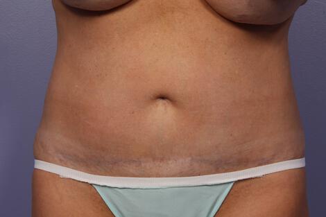 CoolSculpting Gallery Before & After Image