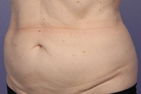 CoolSculpting Gallery Before & After Image