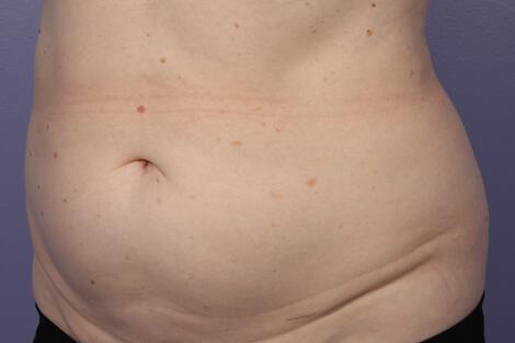 CoolSculpting Gallery Before & After Image