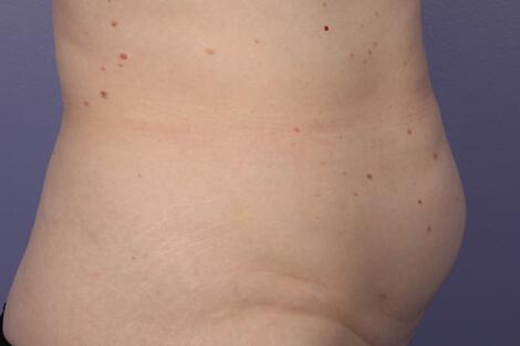 CoolSculpting Gallery Before & After Image