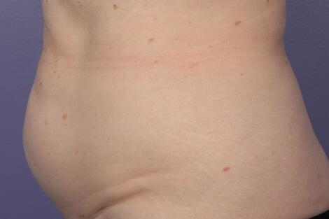 CoolSculpting Gallery Before & After Image