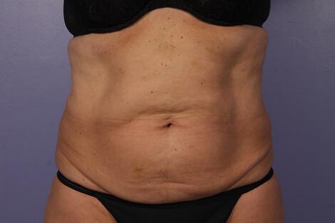 CoolSculpting Gallery Before & After Image