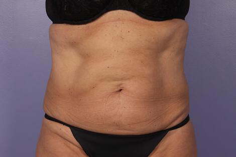 CoolSculpting Gallery Before & After Image