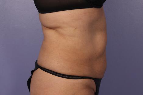 CoolSculpting Gallery Before & After Image