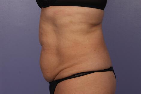 CoolSculpting Gallery Before & After Image